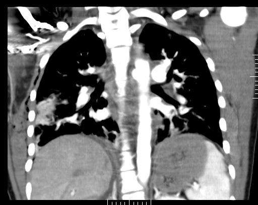CT Reformations Patient MG Excellent