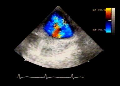 TEE Small arrow indicates pseudoaneurysm Similar blood flow velocities seen on either side of medial flap. Mosaic of colors represents turbulent flow at site of tear.