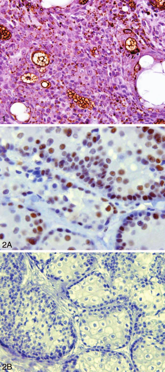 Figure 1. Adipophilin in sebaceous carcinoma (original magnification 3600). Figure 2. Sebaceous carcinoma. A, Normal nuclear staining with MLH1.