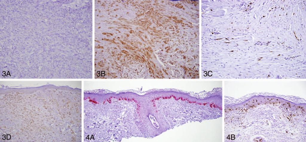 Figure 3. A, Absent MART-1 reactivity in the dermal component of desmoplastic melanoma. B, Diffuse S100 expression in desmoplastic melanoma. C, Focal, horizontal, S100 þ cells in a scar.