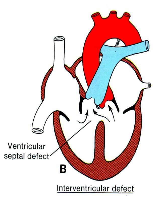 Ventricular Septal Defect VSD: Determinants of L to R shunt Size of VSD Difference in