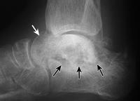 Pitfalls: Look at Subtalar Joint Subchondral collapse can occur at the