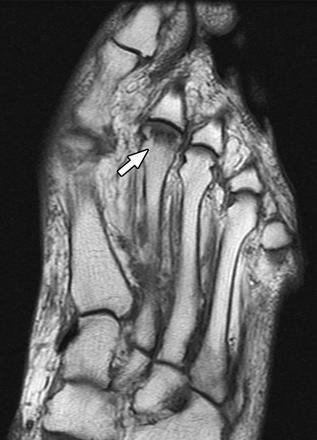 MRI Appearance MRI: Well before plain radiographs show abnormality: