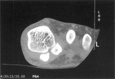 CT of Medial Sesamoid: Stress Fracture