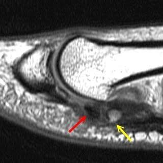 MRI : Avascular Necrosis of Sesamoid To distinguish AVN from stress fractures. AVN: Low T1 and T2 signal.