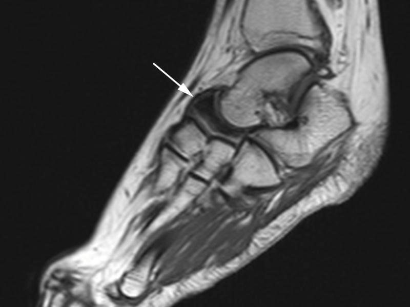 Osteochondrosis of Navicular