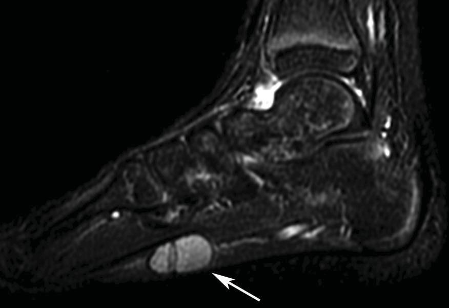 Synovial Sarcoma STIR STIR Most common soft tissue malignancy of foot and ankle in children Named