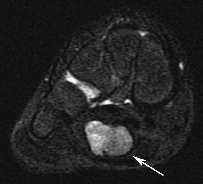 tumors often have nonaggressive appearance, often cyst-like on precontrast imaging There may be