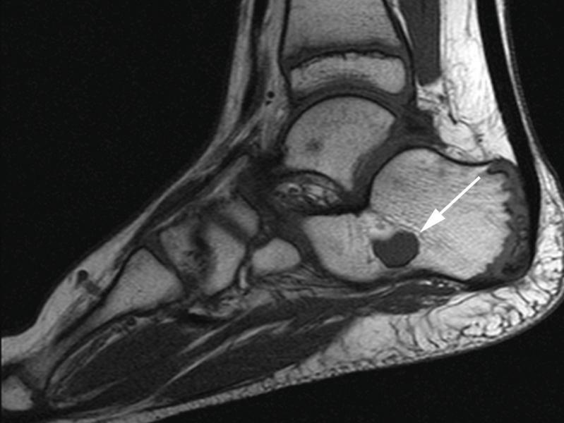 Calcaneal Bone Cyst Critical cysts are at risk for