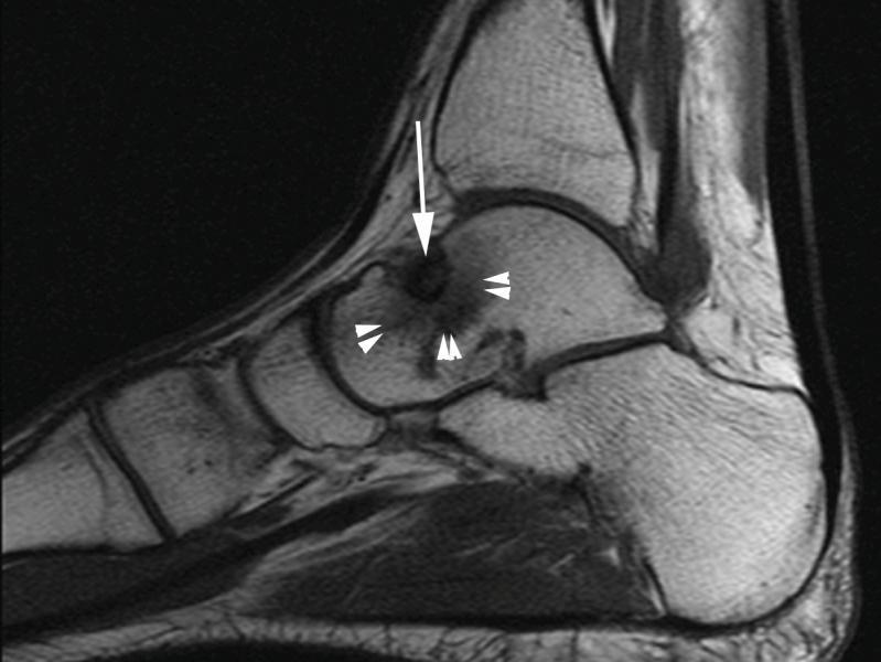 Osteoid Osteoma In the distal lower