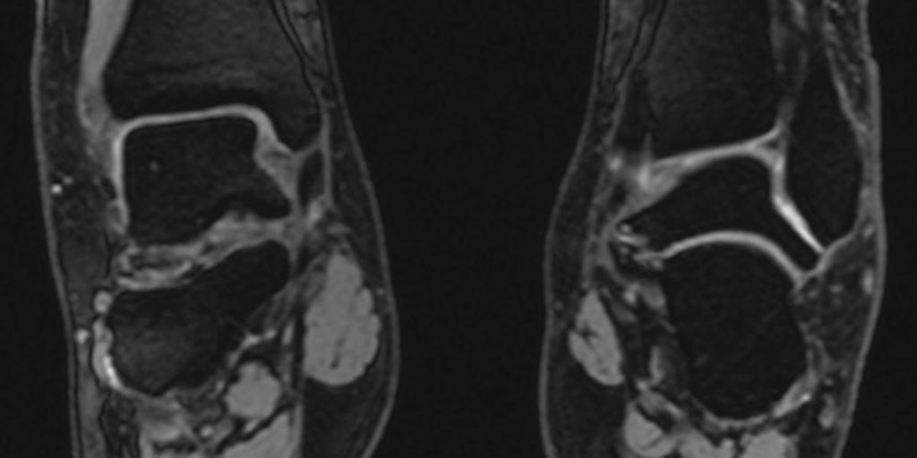 Tarsal Coalition Osseous, cartilaginous or fibrous