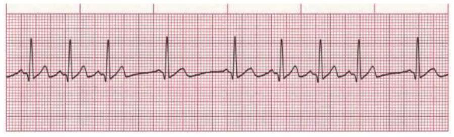 Sinus Arrhythmia Rate Regularity P waves PR interval QRS duration 60-100 bpm irregular