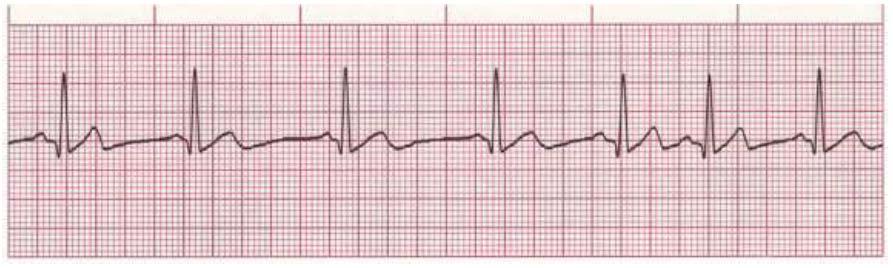 Wandering Pacemaker Rate Regularity P waves PR interval QRS duration 40-60 bpm slightly