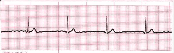 Junctional Bradycardia Rate Regularity P waves PR interval QRS duration <40