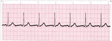Accelerated Junctional Rate Regularity P waves PR interval QRS duration 60-100 bpm