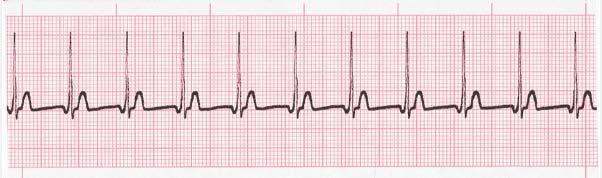 Junctional Tachycardia Rate Regularity P waves PR interval QRS
