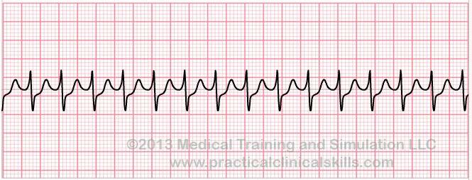 Supraventricular Tachycardia (SVT) Rate Regularity P waves PR interval QRS duration