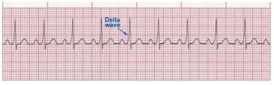 Wolf Parkinson White (WPW) The pacemaker impulse bypasses the AV Node Rate: 60-100 bpm Rhythm:
