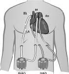 4.6 Types of Support 4.6.1 Isolated LVAD Left ventricular support is the most commonly used form of VAD support for patients unable to be weaned from CPB because the left heart performs the most work