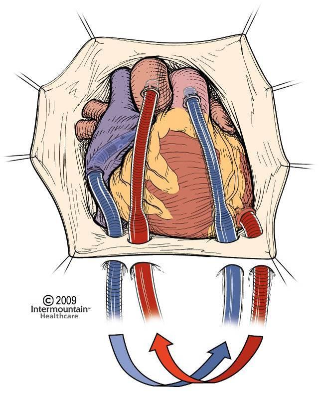 Figures 10 and 11. Standard cannulation for biventricular VAS support. On the left the left ventricle is cannulated via the left ventricular apex and on the right via the left atrium.