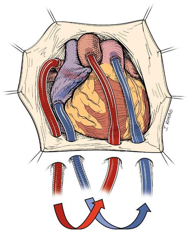 For return blood flow the 22-Fr outflow cannula is inserted into the ascending aorta. All cannulae are secured with dual pledgeted purse string sutures.