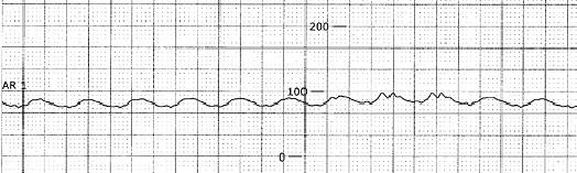 Figure 12. Arterial pressure tracing with complete unloading of the left ventricle resulting in a flat arterial pressure waveform. Figure 13.
