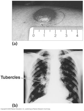 TB Diagnosis 34 Pertussis (Whooping Cough) Initially cold-like, then characteristic cough develops Pathogen and virulence factors Bordetella pertussis is the causative agent Virulence factors include