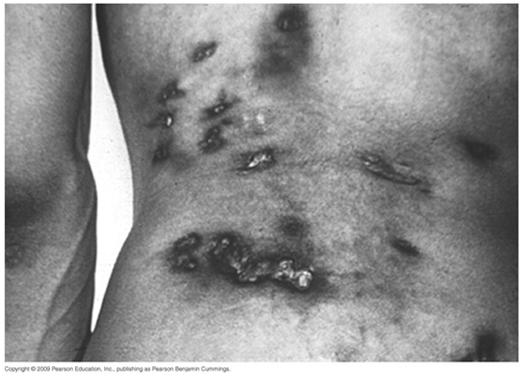 Some Mycoses of the Lower Respiratory System Coccidiodomycosis Resembles pneumonia or tuberculosis Infection can become systemic in immunocompromised persons Pathogen and virulence factors Caused by