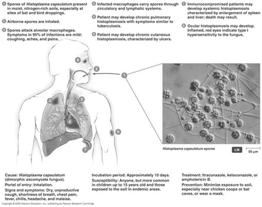 Commonly asymptomatic or subclinical, some severe (~5%) cough w/ blood in sputum, skin lesions Inhalation leads to