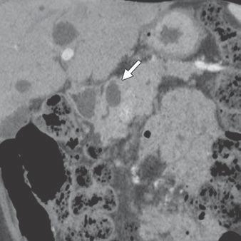 Technologic innovations in MDCT and MRI have led to improvement in analysis and morphologic differentiation of cystic pancreatic lesions and are widely considered the primary imaging modalities in