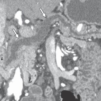 These techniques are particularly valuable in delineating the relation between the cystic lesion and the pancreatic duct, a key feature in differentiating sidebranch IPMNs from other cystic lesions