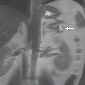 Cystic Pancreatic Lesions Fig. 2 54-year-old man with incidentally detected lesion in pancreatic tail. A, Axial MDCT image shows 8-mm low-attenuation lesion (arrow) in pancreatic tail.