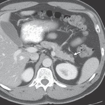 B, Axial T2-weighted MR image shows T2 hyperintense lesion in tail of pancreas with mild nodular wall thickening (arrow) along lateral wall. C, Coronal T2-weighted MR image shows septate cyst (arrow).