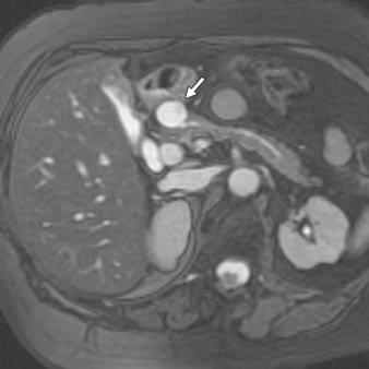 Sahani et al. [37, 38]. An additional advantage of MRI with or without MRCP is in the follow-up of young patients with cystic pancreatic lesions because MRI eliminates exposure to ionizing radiation.