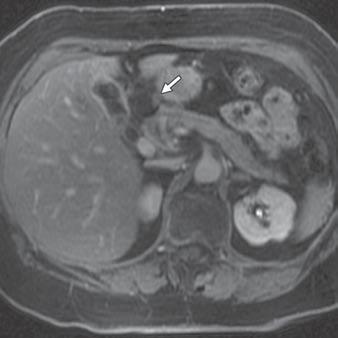 anastomoses [39]. Secretin-enhanced MRCP is a modified MRCP technique in which MRI is performed after stimulation of pancreatic exocrine function by IV injection of secretin [36, 37, 40].