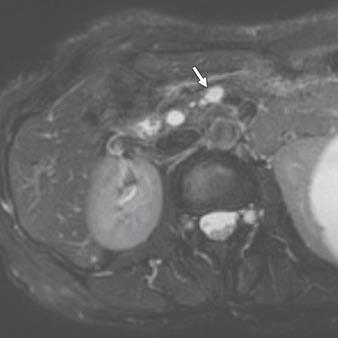 A, Axial T2-weighted MR image shows 17-mm hyperintense lesion (arrow) in pancreatic head.