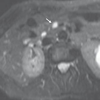 C and D, Follow-up MR images 1 year after B show nodule (arrow) within lesion on T2-weighted image (C) that was enhancing on gadolinium-enhanced T1-weighted fat-saturated image (D).