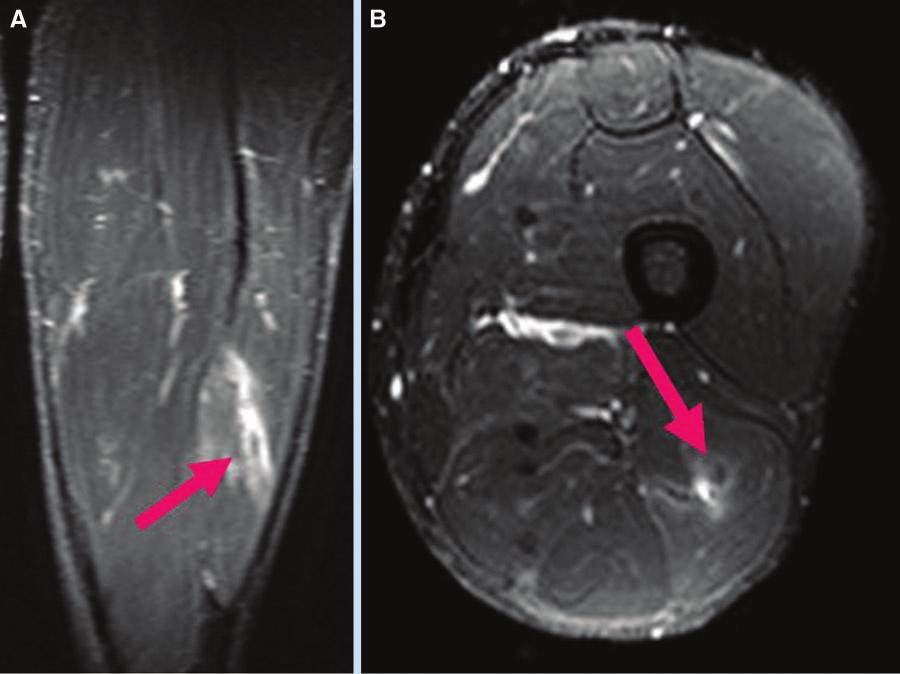vol. 3 no. 5 SPORTS HEALTH Figure 2. MRI of player with rapid return to play: single muscle and low percentage of muscle involvement. A, coronal T2-weighted view; B, axial T2-weighted view.