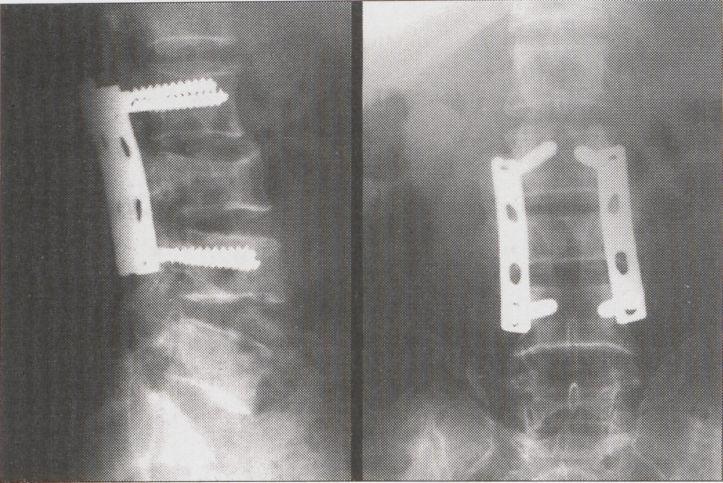 vertebral segment height is reduced to 78%.