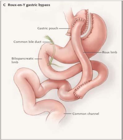 Gastric Bypass Sleeve Gastrectomy