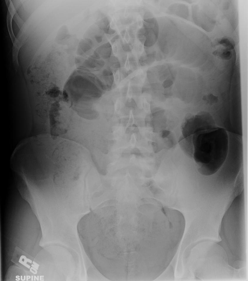 Patient 1: returns 1 year later with severe abdominal pain Dilated loops of air filled small bowel. Distal large bowel is fairly decompressed.