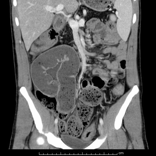 Patient 1: Coronal CT with IV contrast Dilated, fecalized SB loops filled with semi-solid fecal matter. Note that this is abnormal - the SB should be filled with only fluid and gas.