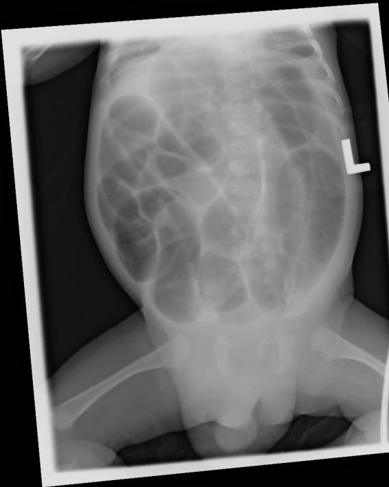 Patient 3: Inguinal hernia Multiple loops of dilated small bowel No apparent transition point Upon close inspection of