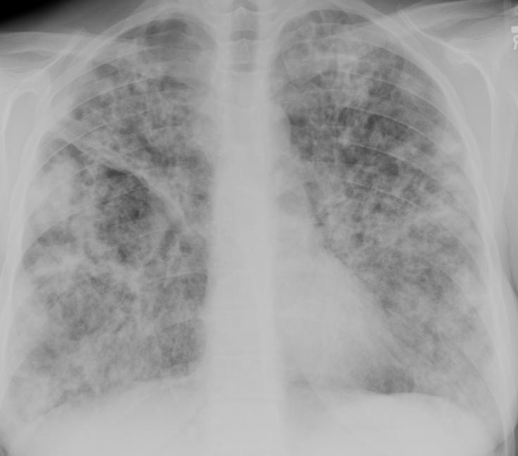 Markedly abnormal Coarse, reticular interstitial diffuse infiltrates Significant scarring, most notably along the minor fissure of the right lung Consistent
