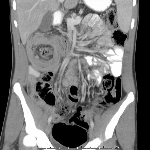 Patient 1: Intussusception on Coronal CT Coronal CT slice with IV contrast showing a classic image of bowel within bowel, diagnosing an intussusception.