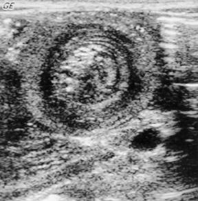 Patient 1: Intussusception on US This slide is not from this patient, but demonstrates the classic target lesion of intussusception on ultrasound.
