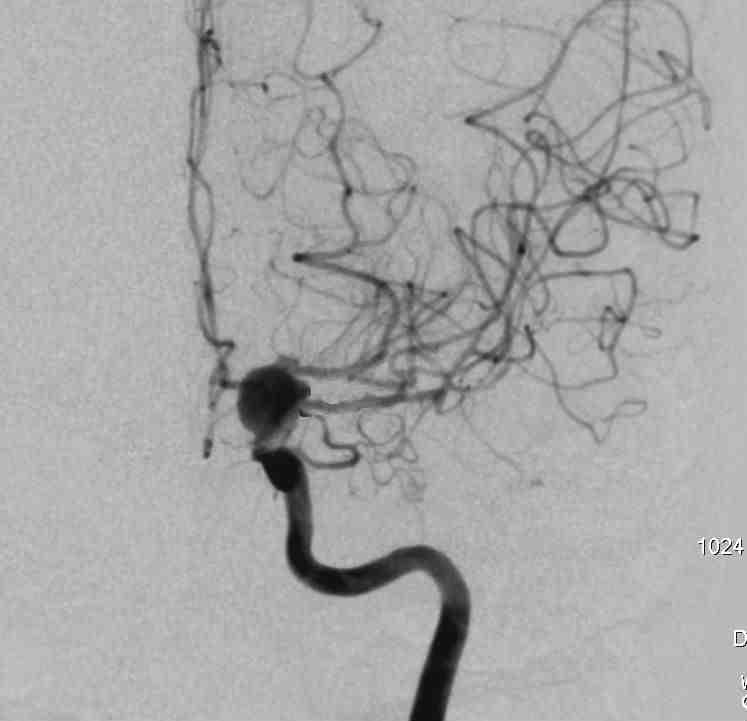 voluminous left internal carotid artery aneurysm (ophthalmic