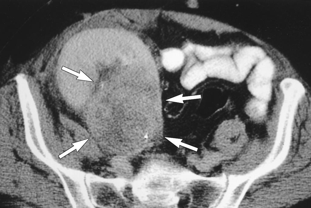 , ontrast-enhanced T scan shows heterogeneously enhancing mass in region of renal pelvis (arrows).