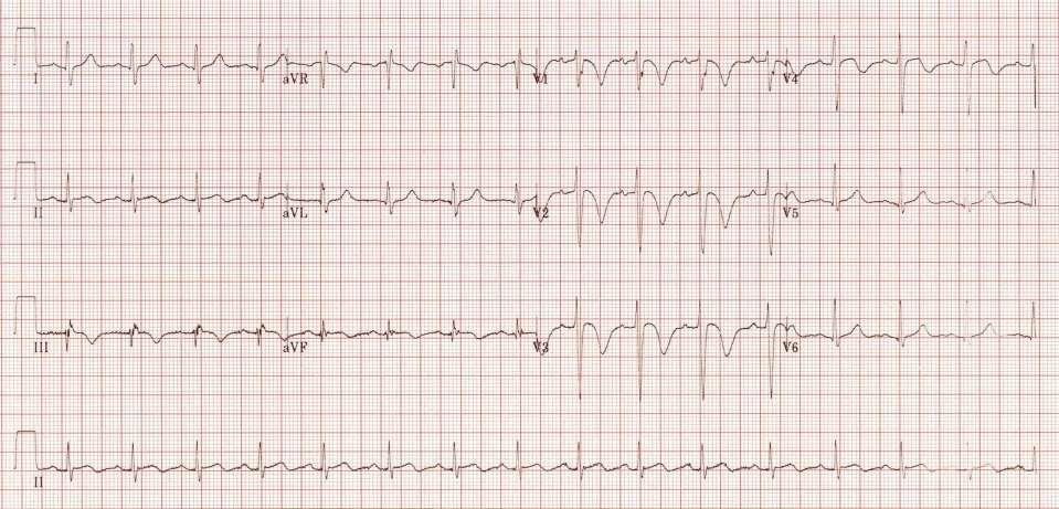 Diagnosis Electrocardiographic Changes Sinus tachycardia, simultaneous T-wave inversions in the anterior (V1-4) and inferior leads
