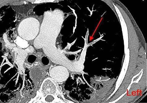 Diagnosis Multi-detector Computed Tomographic Angiography Pulmonary emboli in the middle and in the anterior branches of the left lung (arrow), and several lung